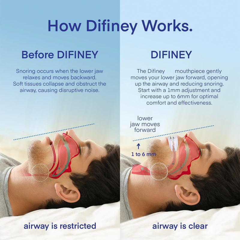 [Australia] - Anti Snoring Device: Anti Snoring Mouthpiece Device Mouth Guard - Effective Anti Snore Solution for Men and Women 