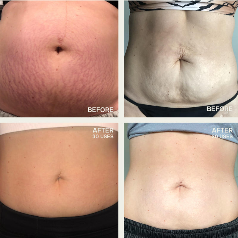 [Australia] - Dermaclara Large Body Patch - Pregnancy Stretch Mark Prevention & Removal, C Section Cover Up Belly Scar Sheet, Maternity Skincare, Mom to Be Silicone Gel Sheet, Reusable up to 30 Times - 1 Patch Body Patch 7" Patch 