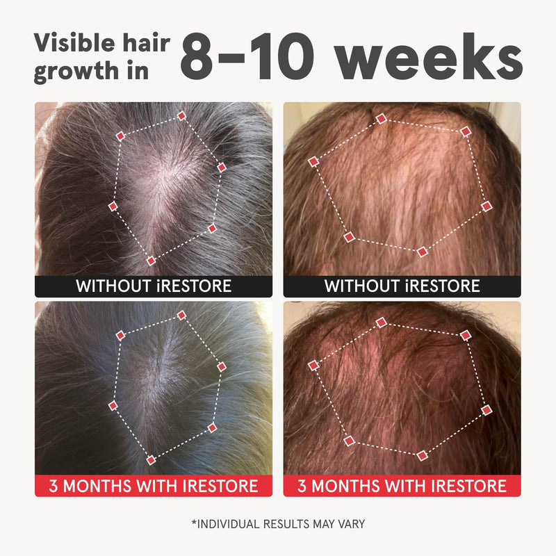 iRestore Advanced Hair Growth Supplement for Women with Lustriva, Hair Vitamins for Faster Hair Regrowth, Best for Hair Loss and Thinning, 1 Month Supply - 1 Count (Pack of 1) - Black Pack of 1
