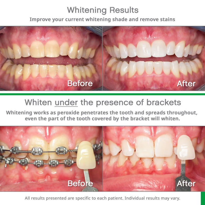 [Australia] - Opalescence Go 10% - Prefilled Teeth Whitening Trays Kit (10 Treatments) - 10% Hydrogen Peroxide - Mint Made by Ultradent Products. Go Teeth Whitening Kit -Mint- GO10-5193-1 