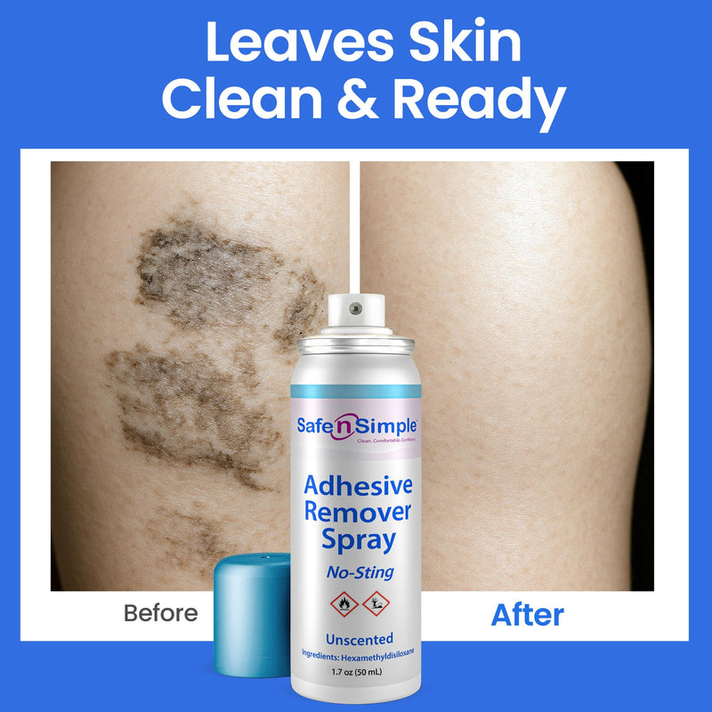 [Australia] - Safe n‚Äô Simple Medical Adhesive Remover Spray for Skin - 1.7 Fl Oz No Sting Alcohol Free Ostomy Adhesive Remover - Gentle Medical Adhesive Removal Spray for Stoma, Urostomy, Ileostomy & Colostomy Care 