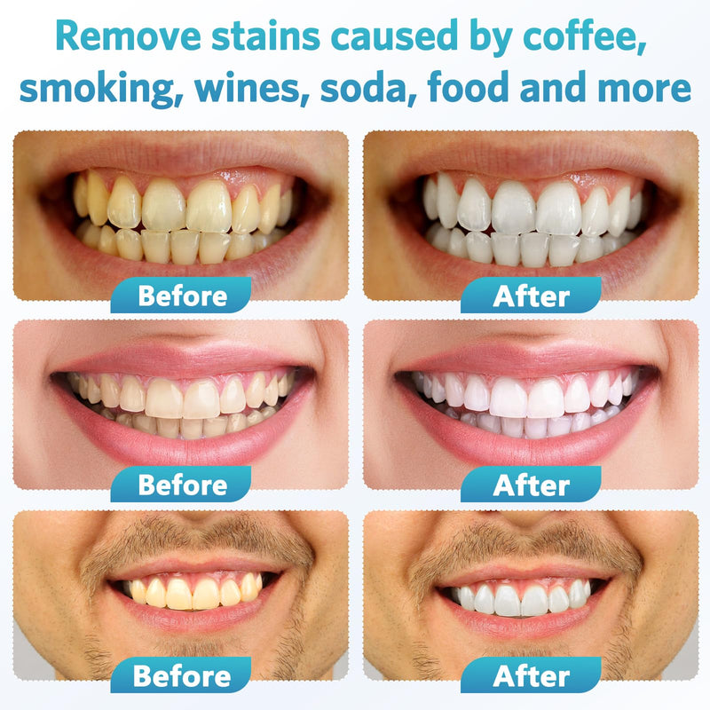 [Australia] - BESTEK Teeth Whitening Kit ‚Äì 32X LED Light, 10-Min Fast Whitening, 4 Tubes of 35% Carbamide Peroxide Gel, Removes Coffee, Wine & Tobacco Stains - Yellow 