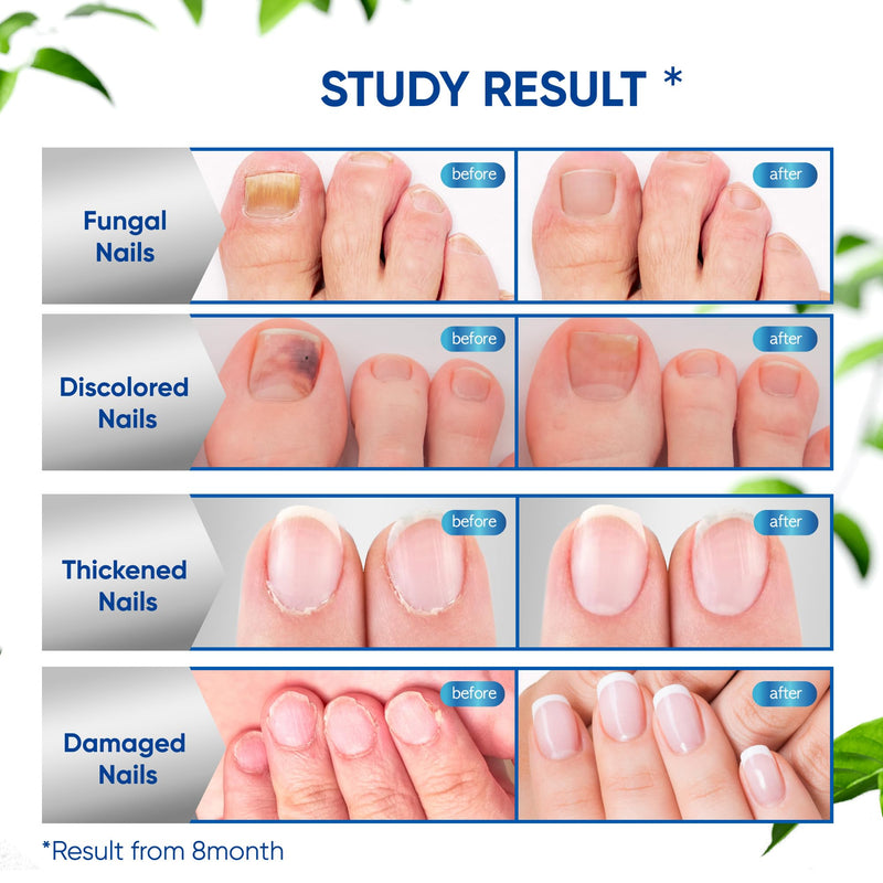 Maximum Strength Toenail Fungus Treatment with 10% Undecylenic Acid - Professional Antifungal Nail Solution for Severe, Thick & Brittle Nails 30ml