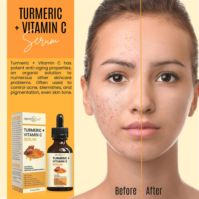 Turmeric Serum for Face + Glow-Boosting Vitamin C Serum –Organic Moisturizer for Acne, Dark Spots & Clear Skin– Boosts Hydration for Dry & Tired Skin – Anti-Aging Formula for Glowing Skin, 4 FL OZ 4 Fl Oz (Pack of 1)