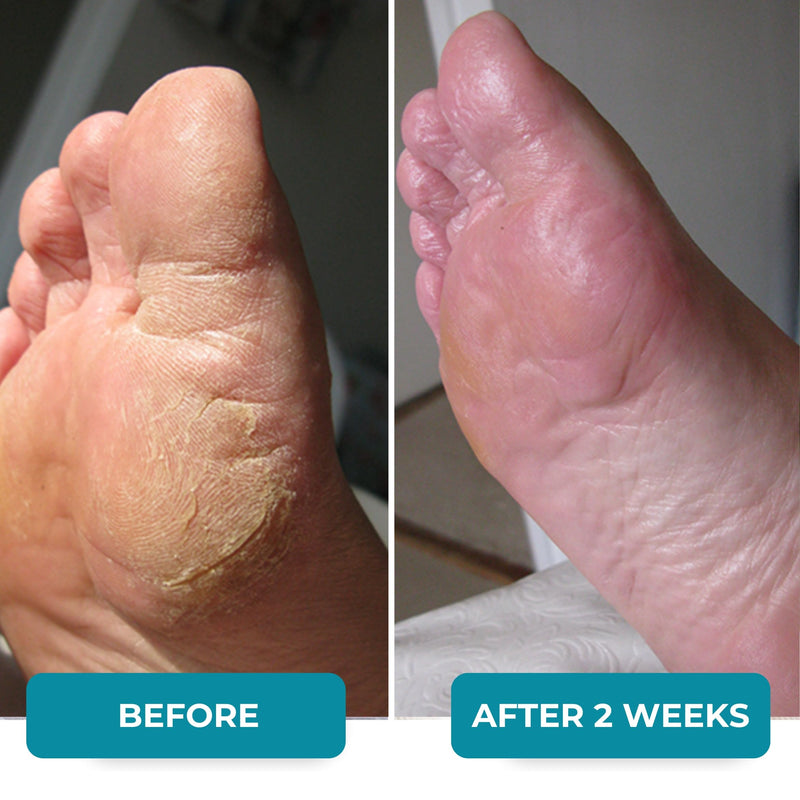 [Australia] - Norelie FeetRenu Foot Soak with Tea Tree Oil and Epsom Salt, Hydrating Foot Soak for Relaxation, Foot Soaking Salts for Cracked Heels and Tired Feet, Soothes Achy Feet and Softens Skin 