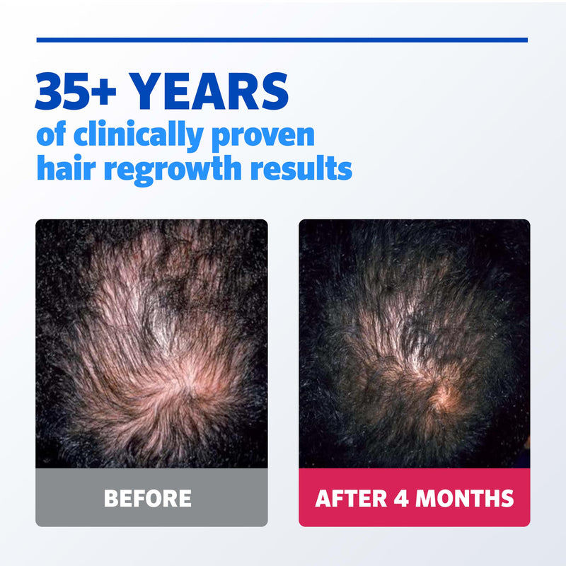 Men's Rogaine Extra Strength 5% Minoxidil Solution, 1 Mo Supply, 2 Fl Oz Solution Topical Treatment (1-Month Supply)