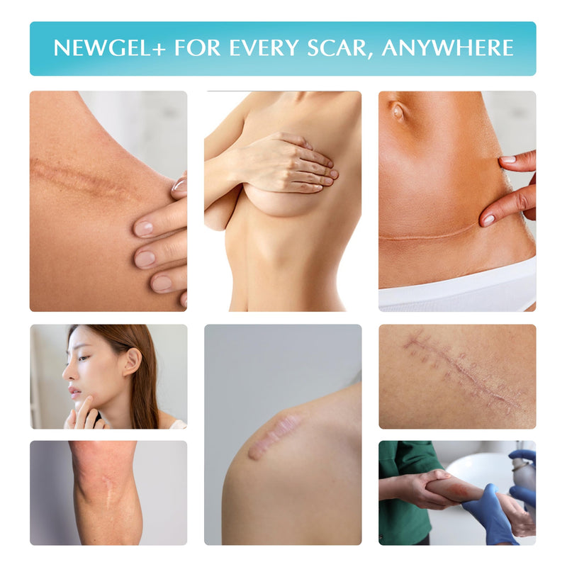 [Australia] - Advanced High-Potency Silicone Scar Gel with Vitamin E for Old, New Scars, Surgery, Keloids, Burns, and Facial Blemish Scars, NewGel Plus by MyNewGel (15 Grams) - 0.50 oz 0.5 Ounce 