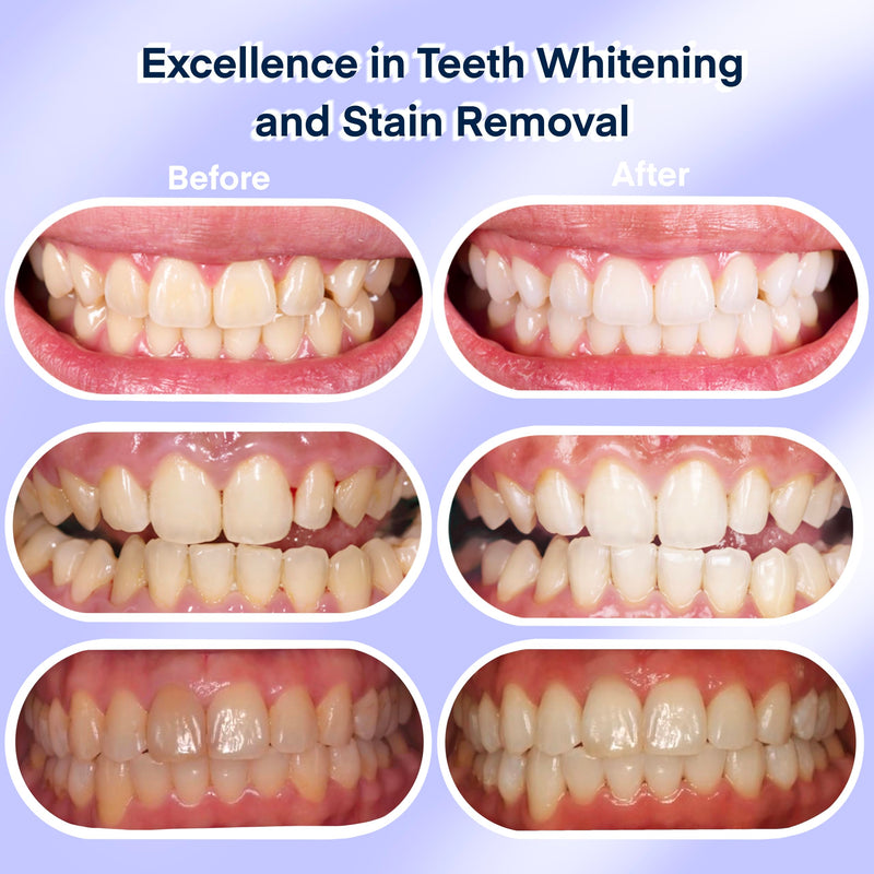 [Australia] - American Teeth Whitening Kit, Teeth Whitening Gel, Pen, Whitening Trays with Light, 25 Uses, Whiten Up to 8 Shades in 1 Week, 2025 Powerful Teeth Whitener 