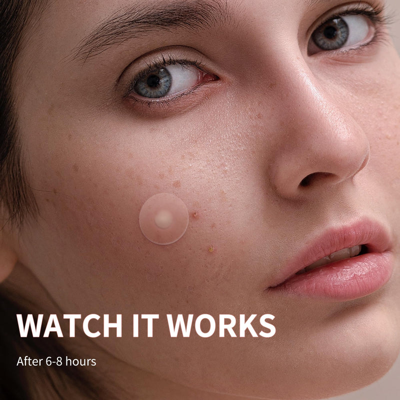 [Australia] - Pimple Patches for Face, 4 Size 300 Counts Acne Patches, Hydrocolloid Patches for Covering Zits and Blemishes, Spot Stickers with Salicylic Acid, Tea Tree Oil & Calendula Oil 