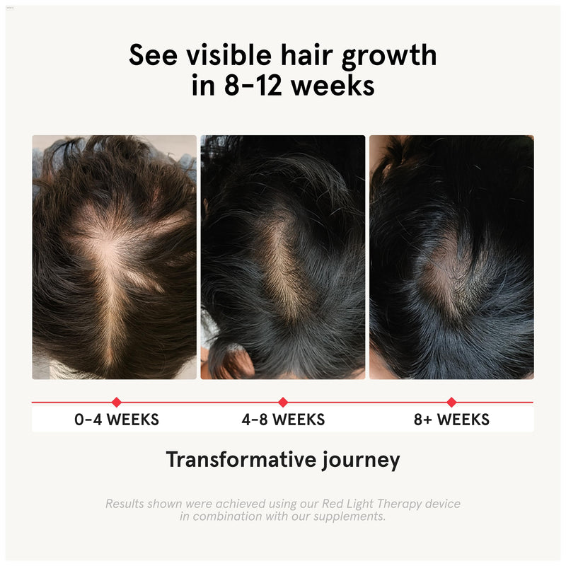 iRestore Hair Growth Supplement - Hair Loss Vitamins for Women and Men - Biotin Multivitamins & DHT Blocker to Reduce Hair Thinning - Hair Regrowth Pills - 30 Days Supply 90 Count (Pack of 1) 90 Count (Pack of 1)