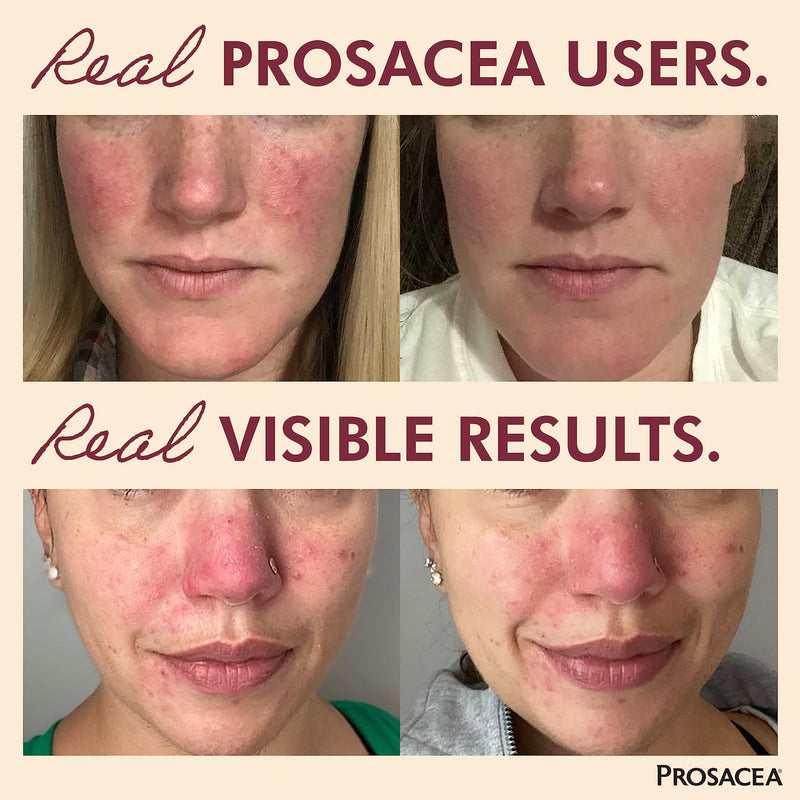 [Australia] - Prosacea - Heals Rosacea Symptoms of Redness, Pimples and Irritation - 0.75 oz Pack of 1 