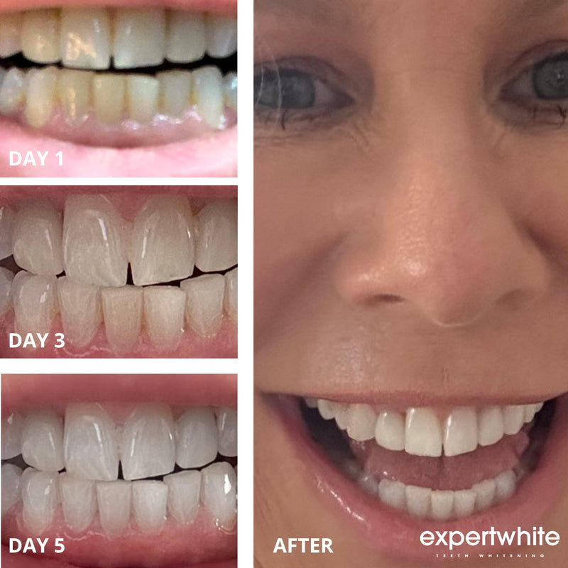 [Australia] - Extreme 44% Teeth Whitening Gel (6-gels) 