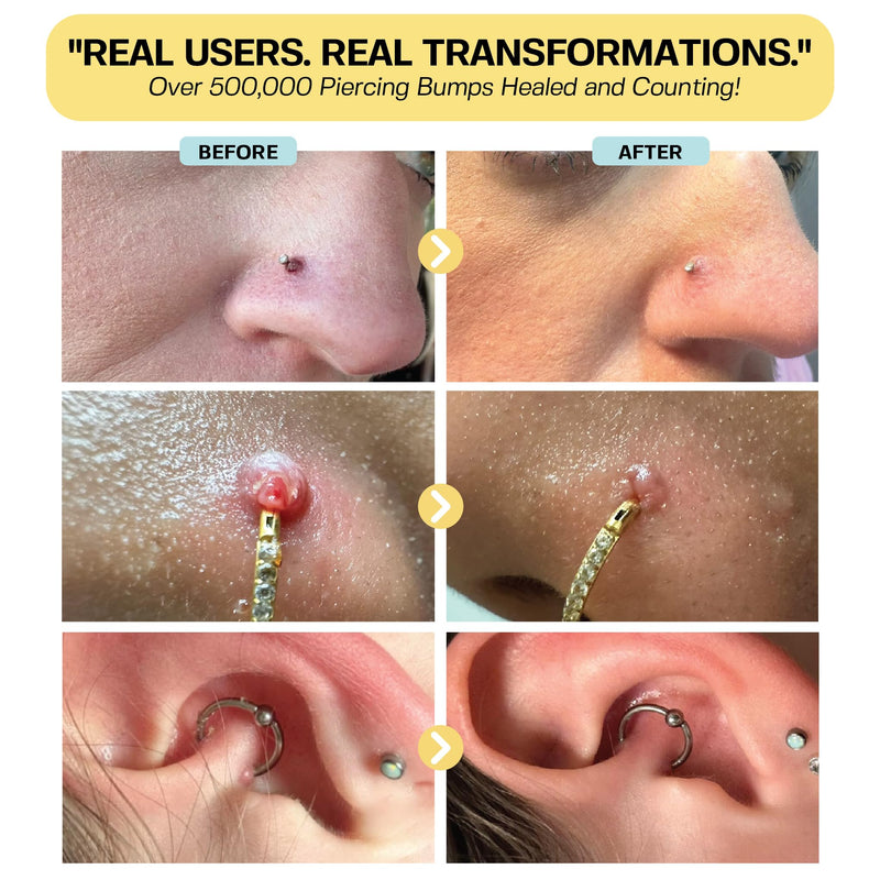 [Australia] - BASE LABORATORIES Piercing Keloid Bumps Shrinking Duo | Piercing Bump Treatment (.5oz) + Keloid Bump Removal Gel (2oz) | Keloid Scar Removal for all Scars, Keloids & Piercing Bumps 