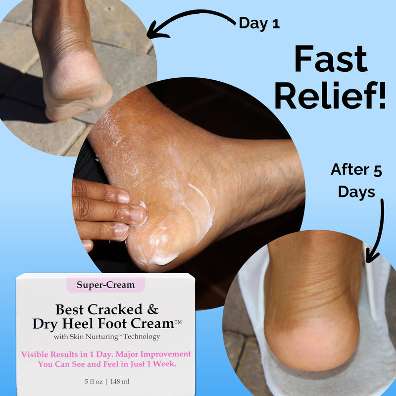 [Australia] - Best Cracked & Dry Heel Foot Cream™ Urea Ceramides Heels Feet Knees Elbows Hands Dead Skin Cuticle Callus Remover Nail Softener Keratolytic Repair Mango Cocoa Shea 5oz 