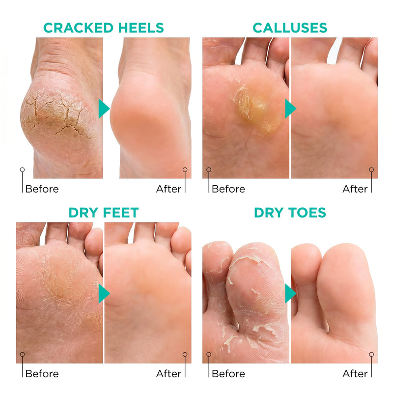Foot Peel Mask for Dry Cracked Feet – 2 Pack Peeling Mask Removes Dead Skin and Calluses - Exfoliating for Soft Baby Feet, Original Scent Aloe Vera 1 Count (Pack of 2)