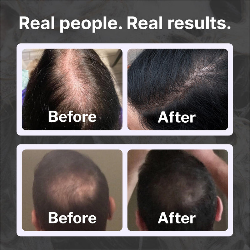 Shapiro MD Hair Growth Experts DHT Fighting Hair Loss Shampoo, 1 Month | Dermatologists Developed Formula for Thinning Hair | Experience Healthier, Fuller and Thicker Looking Hair 8 Fl Oz (Pack of 1)