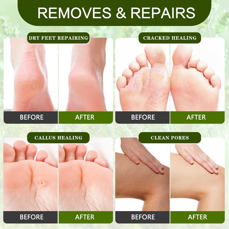 [Australia] - Foot Callus Remover Gel Kit Heel Exfoliator Dead Skin Remover Pedicure Foot Spa Products Set Home Pedicure Foot Care Spa Supplies for Rough, Dry, Cracked Skin Cracked Heel, Professional 