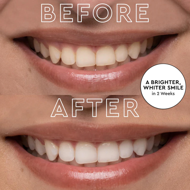 [Australia] - MOON Teeth Whitening Kit, LED Light Teeth Whitener Device, 56 White Strips, USB Charger & Travel Case, Blue Light Whitening Tray Removes Stains & Whitens Up to 12 Shades in 2 Weeks (4 Piece Kit) 