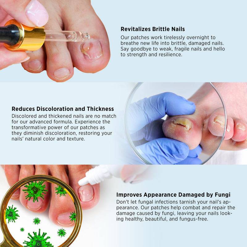 Toenail Fungus Treatment Extra Strength - Nail Fungus Treatment For Toenail Extra Strength - Nighttime Nail Patches & Nail Treatment Liquid Set (32patches+15ml) 32 PCS Medium Patches + 15mL Liquid