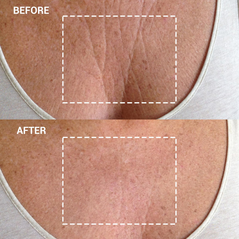 [Australia] - Wrinkles Schminkles Chest Wrinkle Patch - Reusable Silicone Smoothing Pads for Cleavage & Body, Reduce Wrinkles & Stretch Marks, Sensitive Formulated, Secret to Radiant Skin (1 Pack) 1 Count (Pack of 1) 