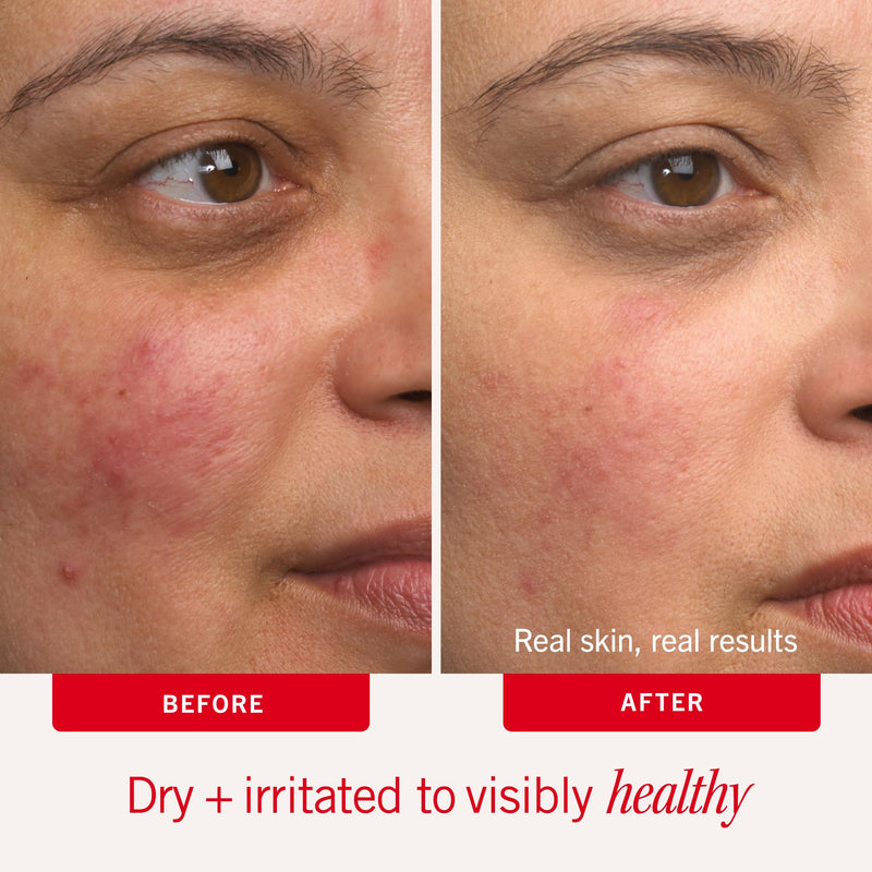 First Aid Beauty Ultra Repair Cream, Intense Hydration - Clinically Tested Face & Body Moisturizer with Colloidal Oatmeal - Supports Eczema & Dry Skin Barrier Repair - Fragrance Free 6 Ounce (Pack of 1) New