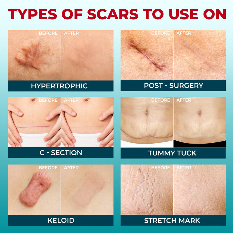 [Australia] - Medical Grade Silicone Scar Tape - 1.6‚Äùx150‚Äù - Visible Difference on Keloid & –°-Section - Reusable Silicone Scar Sheets - Easy to Use Beige 150"x1.6" 