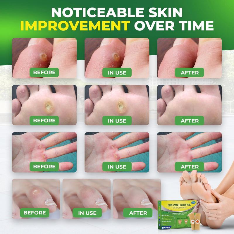 [Australia] - Corn Remover Pads for Feet Toes: 30 Pack 40% Salicylic Acid Extra Strength Treatment - Fast Effective Medicated Bandages for Adults Seniors Teens Athletes Runners Hikers Workers Men Women 30 Count Fresh Green 