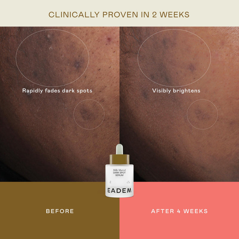 EADEM Dark Spot Remover Serum for Face Infused with Vitamin C & Niacinamide | Milk Marvel, Helps Fade Hyperpigmentation, Minimizes the Look of Pores, Made for All Skin Tones, Dark Spot Corrector, 1.01oz
