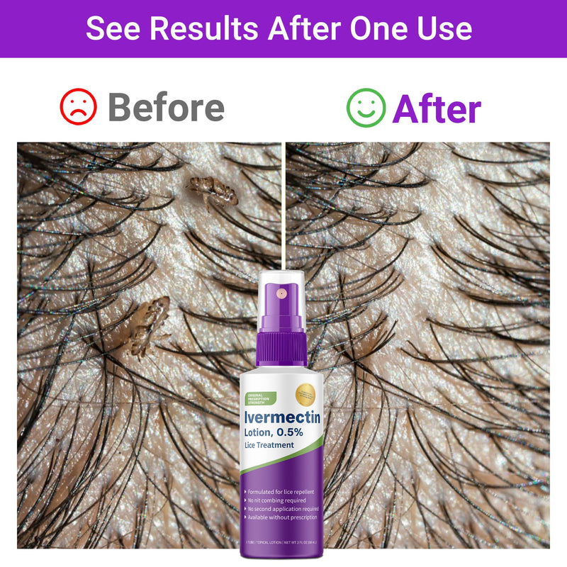 [Australia] - Ivermectin Lotion 0.5%, 2oz, Lice Treatment, No Head Combing Required, Just One Application Will Done 