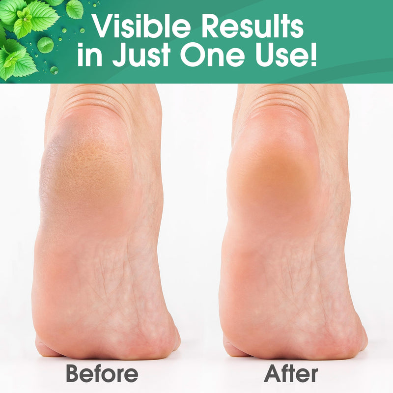 DeEnti Foot Callus Remover Gel, Dead Skin Remover for Feet, 16oz Cool Mint | Extra-strength Cool Mint callus remover gel melts dead, cracked skin for smooth heels, a salon-grade at-home pedicure formula 16 Fl Oz (Pack of 1)