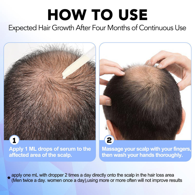 Minoxidil for Men-5% Extra Strength Hair Regrowth for Men Treatment-5% Topical Solution-Dropper Applicator Included -Minoxidil for Women-Stop Thinning & Hair Loss (1)
