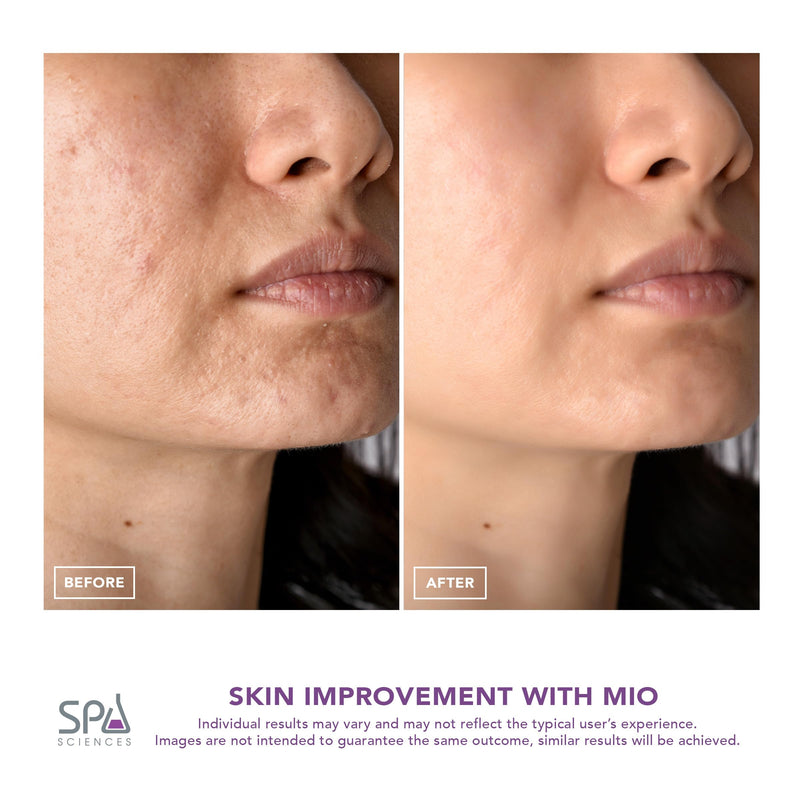 Spa Sciences MIO Diamond Microdermabrasion Blackhead Remover, Pore Suction Tool–Rechargeable-Dermatologist Recommended Skin Resurfacing System for Anti-Aging-Exfoliator for Acne Scars/Wrinkles (Mint) Mint