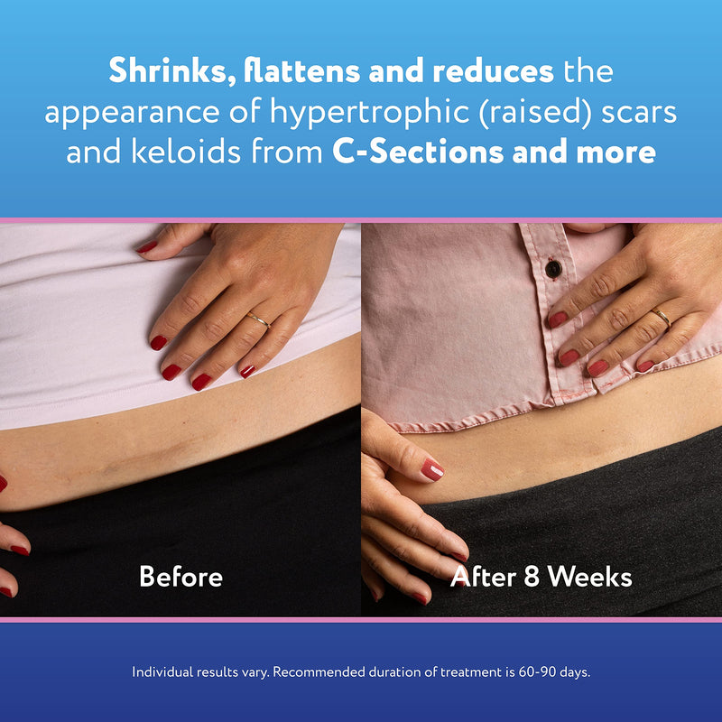 [Australia] - ScarAway Advanced Silicone Scar Sheets for C-Section, Reusable Sheets (1.5” x 7”) for Hypertrophic and Keloid Scars from C-Section & Other Surgeries, 4 Sheets 