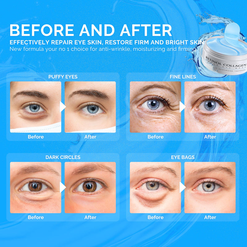 [Australia] - Enaskin Naturals Under Eye Patches for Dark Circles: 30 Pairs Retinol Collagen Eye Gels Mask - Reduce Wrinkles Puffy & Bags - Skin Treatment Pads - Anti Aging Moisturizer For Women (Blue) Blue 
