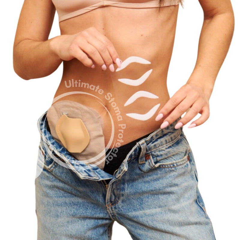 [Australia] - SIIL Stoma Protector | Stoma Guard Shield Protect your Stoma | Ostomy Bags & Ileostomy supplies | FREE 10pcs VELCRO‚Ñ¢ Stickers Beige 