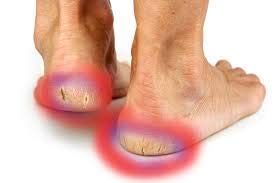 [Australia] - Heal me Silicone Gel insole heel pad for heel pain, Achilles tendonitis, plantar fasciitis, height increase; comfort (UK small 10cm x7.2cm) 