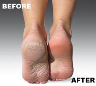 [Australia] - Genuine Emjoi Micro-Pedi Refill Rollers (Extra Coarse) by Emjoi 