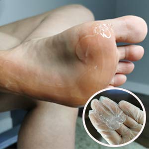 [Australia] - 8oz Callus Remover gel for feet for a professional pedicure. Better results than, foot file, pumice stone, foot scrubber, foot buckets & callus shaver. Rid ugly callouses from feet in minutes 8 Ounce (Pack of 1) 