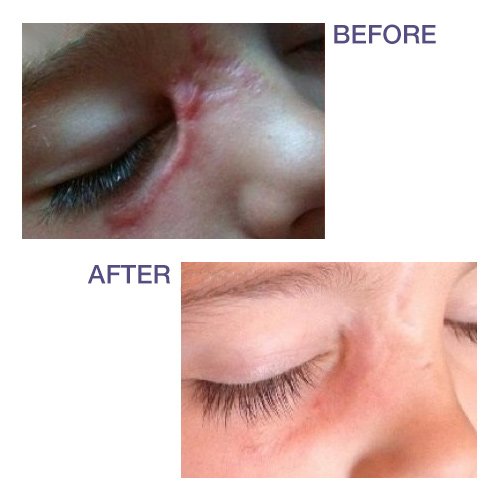 [Australia] - Pro-SIL Silicone Scar Treatment Stick - Patented, FDA Cleared, Clinically Proven to Reduce Scars - Glide-on Applicator, 4.25g, Made in USA 