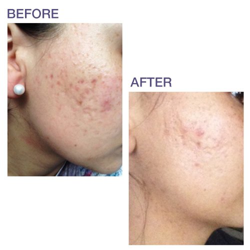 [Australia] - Pro-SIL Silicone Scar Treatment Stick - Patented, FDA Cleared, Clinically Proven to Reduce Scars - Glide-on Applicator, 4.25g, Made in USA 