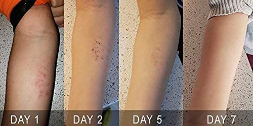 [Australia] - Orellis Natural Eczema Relief Cream with Calendula and Propolis. for Body & Face. Natural Cream for Eczema Relief & Dermatitis. Provides Itch Relief and Reduces Flare ups Caused by Eczema. 