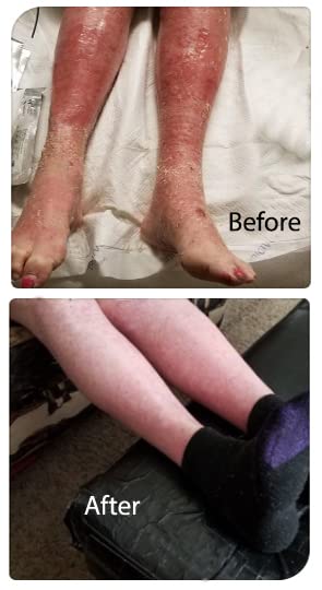 [Australia] - Psorclear-Psoriasis & Eczema Treatment | A Proven Effective and All-Natural Treatment for Psoriasis Eczema & Rosacea Relief That Works (120 Count Bottle) 