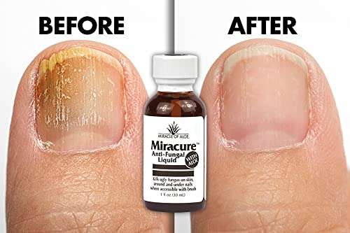 [Australia] - Miracure Anti-Fungal Treatment 1 ounce bottle with 10 Toe Separators and Brush with UltraAloe 