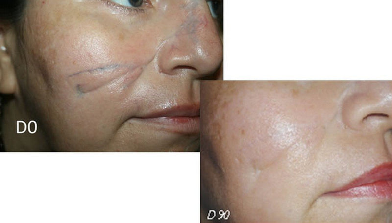 [Australia] - Sodermix for Treatment of Scars - 30g - Psoriasis Eczema Scars 