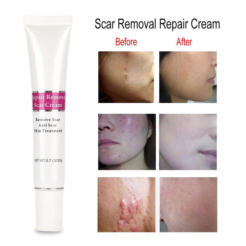 [Australia] - Scar removal cream, anti-scar cream for the relief of old scars and stretch marks and repair of burned skin, scar removal gel is suitable for skin care 
