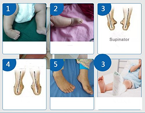 [Australia] - Kids AFO Drop Foot Splint Baby Ankle Foot Brace Night Splint Toddler Strephenopodia Strephexopodia Splint (12cm) 12cm 