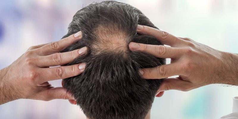 [Australia] - Kerastim Pro Hair Loss Treatment for Men & Women. Promote Hair Growth Serum, Anti-Thinning Formula. Helps Stop Hair Loss Fast & More Effective Than Shampoo. Keratin, Biotin, DHT Blocker 15 x 5ml 