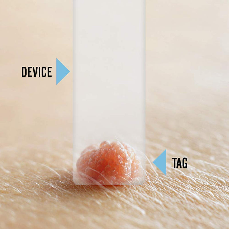 [Australia] - Tagcure PLUS Skin Tag Removal Kit For Easy Skin Tag Removal - Includes x10 Tag Bands x10 Cleaning Swabs & x10 Plasters To Cover Tag Area (For Tags Between 0.5cm - 0.7cm) 