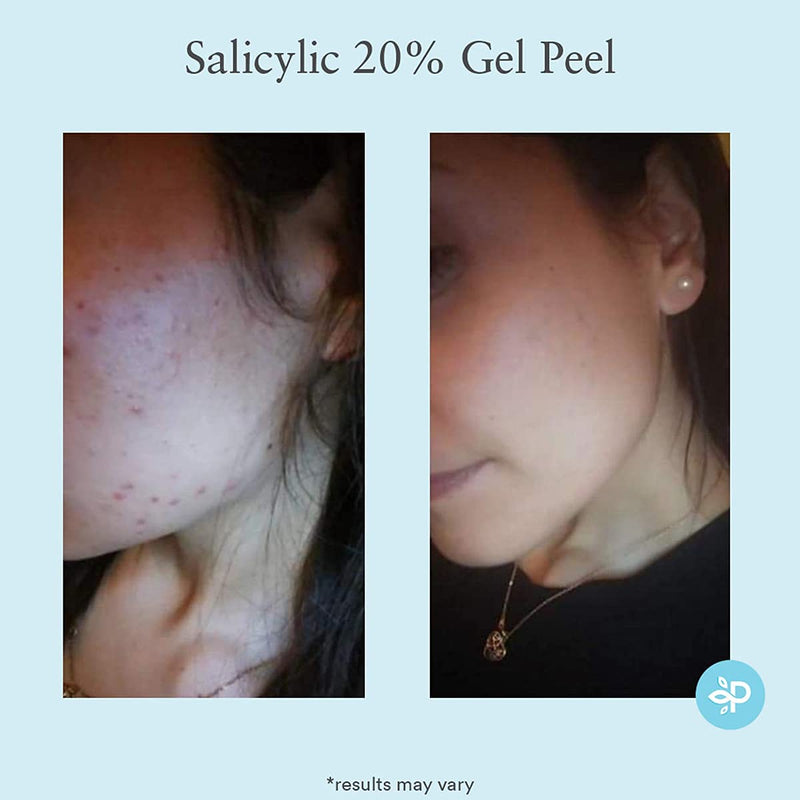 [Australia] - Salicylic 20% Gel Peel, Breakout and Pore Minimizer and Cleanser, Strength Level 2, 15-30 Full Facial Chemical Peels, 1 fl oz. e, 30 ml 