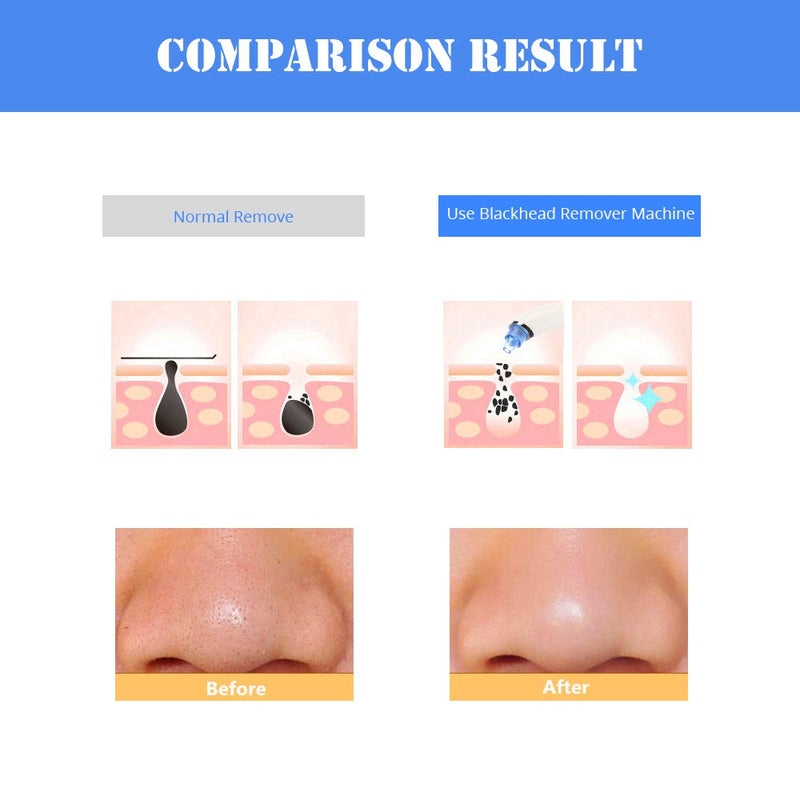 [Australia] - Blackhead Remover - Laiking Facial Pore Vacuum Cleaner Rechargeable Portable Electric Acne Zit Comedone Extractor 4 Suction Head & 3 Adjustable Suction Power for Unisex Nose Pimple Whitehead 